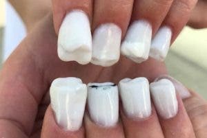 Las uñas con forma de dientes, una sensación