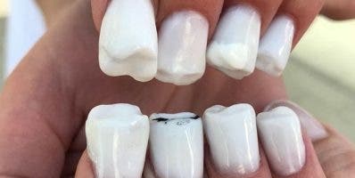 Las uñas con forma de dientes, una sensación
