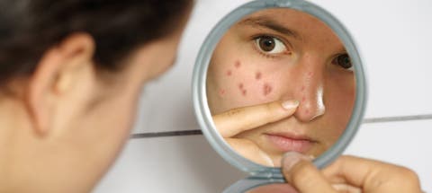 Tratamientos del acné deben apuntar a la regeneración del tejido