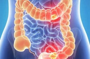 El cáncer colorrectal, una enfermedad que puede confundirse con colitis