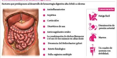 La hemorragia digestiva alta es una amenaza para la vida del paciente