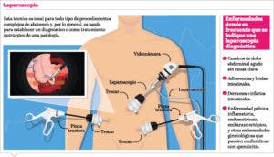 Laparoscopía, una alternativa de menor riesgo al momento de la cirugía