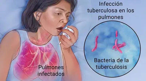 Centroamérica, México y República Dominicana evalúan acciones contra tuberculosis