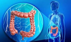 Inmunoterapia puede evitar muertes por cáncer colorrectal, según médico