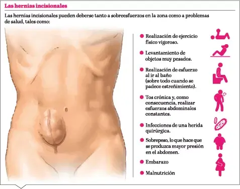 Cómo debe ser el abordaje de las hernias ventrales incisionales