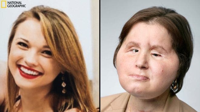 El histórico trasplante de rostro que le dio una segunda oportunidad a una joven que intentó suicidarse