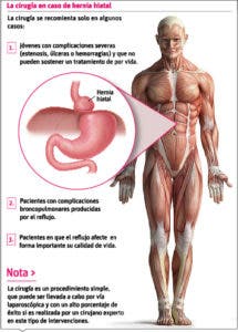 La hernia hiatal es asintomática y puede ser congénita