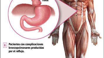 La hernia hiatal es asintomática y puede ser congénita