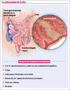 Crohn: Una nueva forma de identificar y tratar esta enfermedad