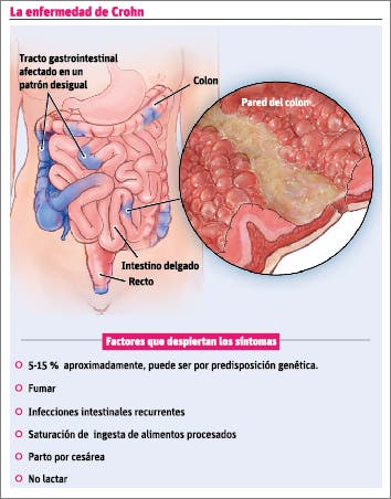 Crohn: Una nueva forma de identificar y tratar esta enfermedad