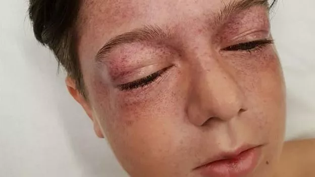 El peligroso reto de YouTube que le causó heridas 