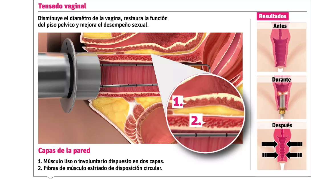 Tratamiento devuelve elasticidad a la vagina