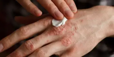 La psoriasis: Un desafío que trasciende la piel