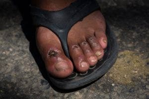 En esta fotografía del 31 de octubre de 2018, moscas cubren una de las ampollas en los pies del migrante hondureño Gerson Noel Rivas después de que una caravana de migrantes que se dirige a Estados Unidos hizo una escala en el poblado de Juchitán, México, tras un día de caminar. (AP Foto/Rodrigo Abd)