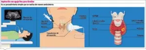 El uso sonografía de tiroides para tratar la lesión nodular