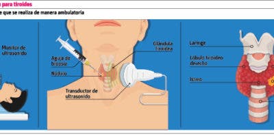 El uso sonografía de tiroides para tratar la lesión nodular