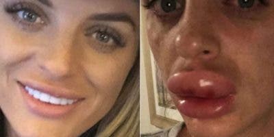 Fiesta de bótox: el trauma de una mujer que terminó en el hospital por la hinchazón de sus labios