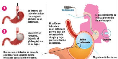 Pacientes con el balón gástrico deben asumir una vida más saludable