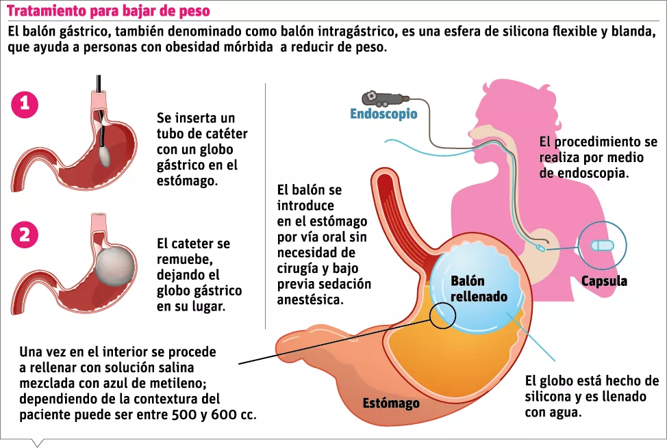 Pacientes con el balón gástrico deben asumir una vida más saludable