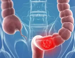 ARAPF: La prevención es clave para la disminución del cáncer colorrectal