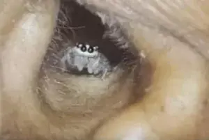 Hombre tenía araña viviendo en su oído