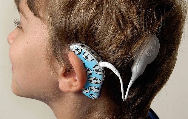 Implante coclear, una solución  para recuperar  la audición