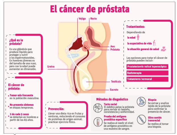 Vigilar sin tratar, otra opción para evitar agravamiento en cáncer de próstata