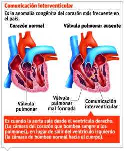 Falta de diagnóstico pone en riesgo vidas de niños con cardiopatías