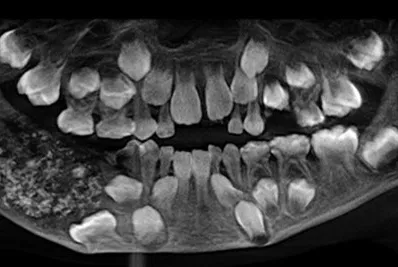 Niño se queja de dolor y le sacan 526 dientes