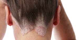 La fangoterapia es una alternativa eficaz para tratar psoriasis capilar