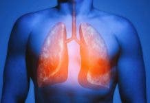 Cáncer de pulmón cobra mayor letalidad que el de próstata, colon y mama, afirma experto