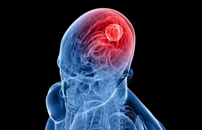 La covid-19 aumenta el riesgo de problemas cerebrales a largo plazo