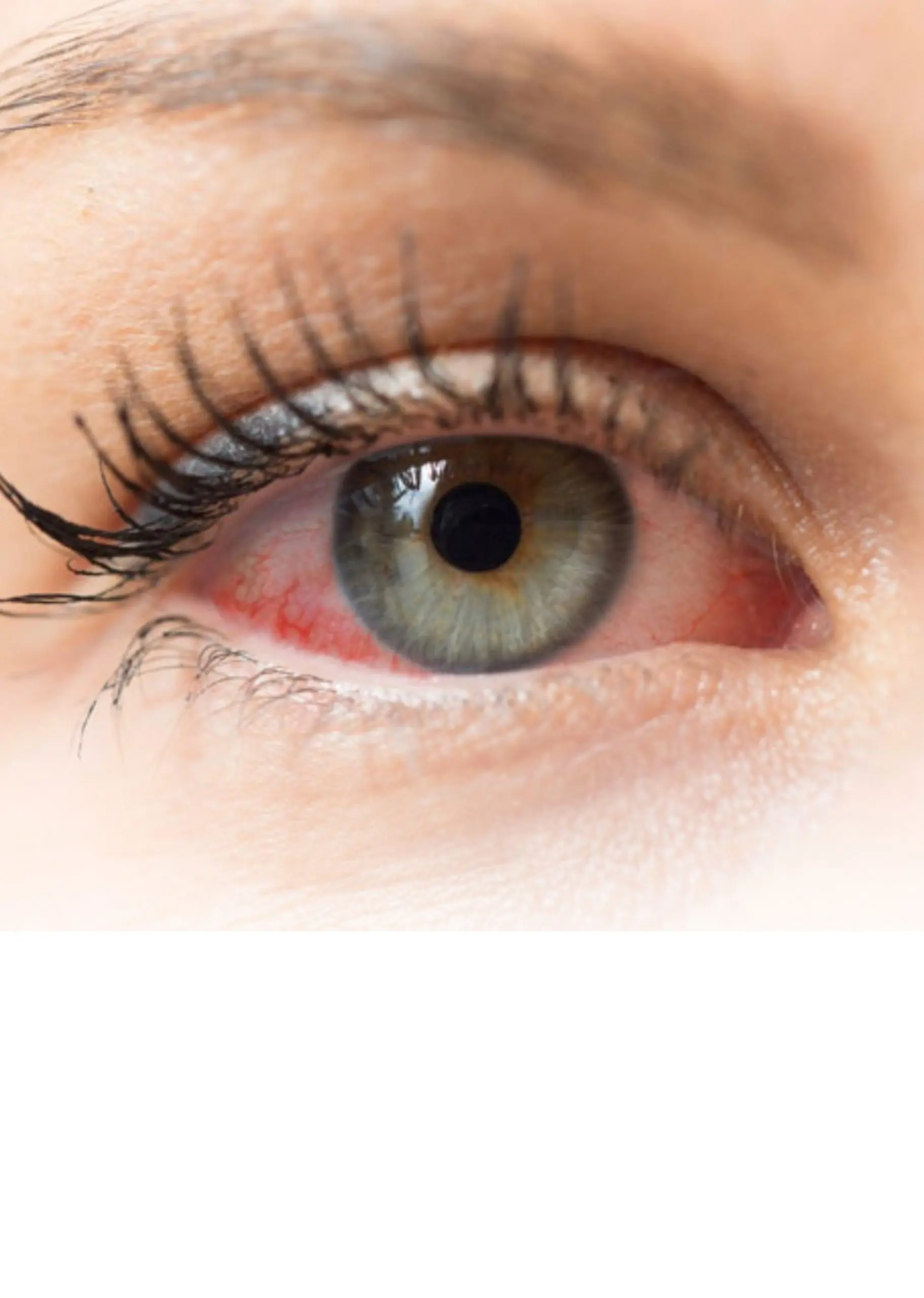 El síndrome del ojo seco afecta glándula y sistema nervioso