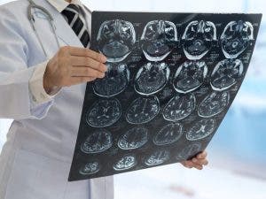 Las alteraciones neurocerebrales que causa el COVID-19