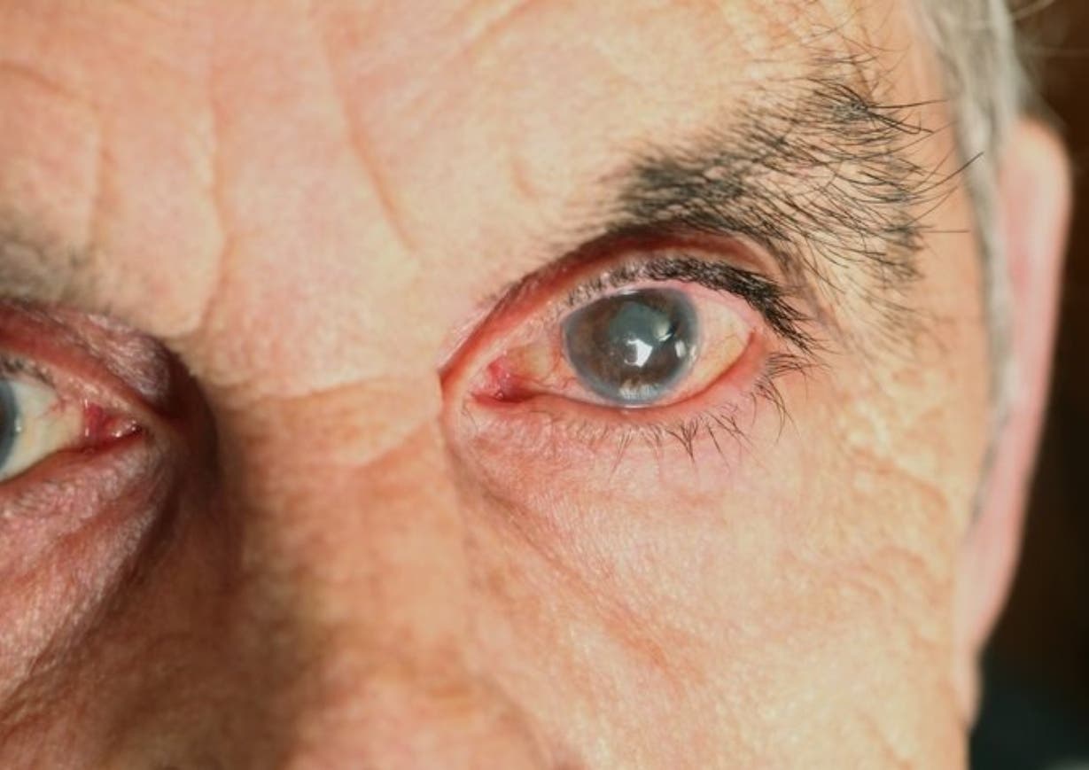 Cómo evitar Síndrome de Enmascaramiento Ocular apague los ojos