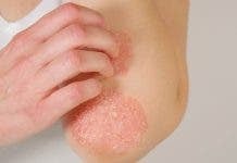 Terapia innovadora para los pacientes con psoriasis