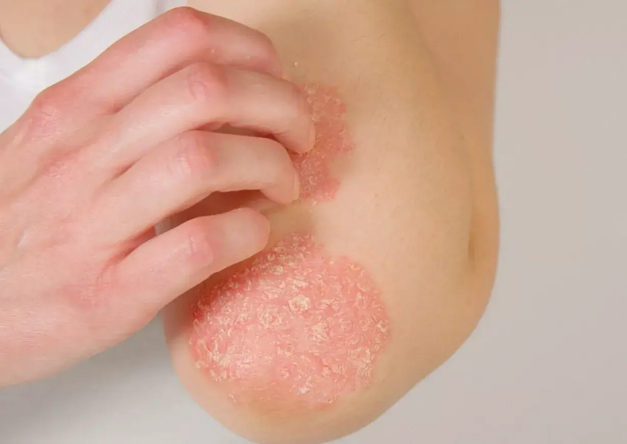 Terapia innovadora para los pacientes con psoriasis