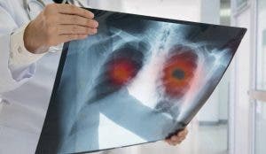 El 36%  casos cáncer de pulmón no es por fumar