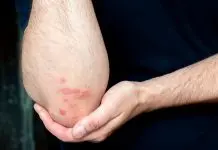 Psoriasis afecta física y emocionalmente