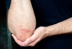 Psoriasis afecta física y emocionalmente