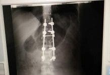 Cirujanos esperanzados tras cirugía a mujer sufrió fractura columna