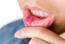 Conoce los 8 remedios naturales para las úlceras en la boca