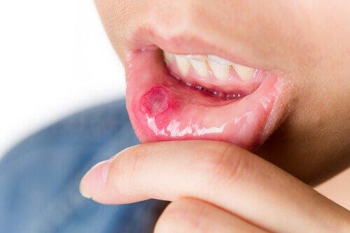 Conoce los 8 remedios naturales para las úlceras en la boca