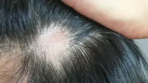 Coronavirus: qué causa y cómo tratar la caída del cabello que afecta a uno de cada cuatro infectados