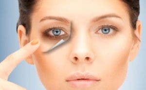 Tratamiento definitivo para eliminar las ojeras