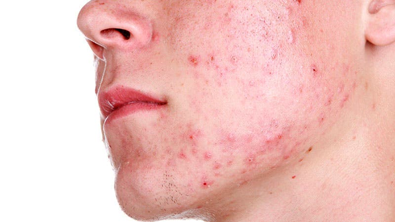 80% de adolescentes sufre acné
