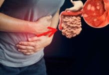 Colitis ulcerativa, condición sin síntomas propios y que se torna invisible