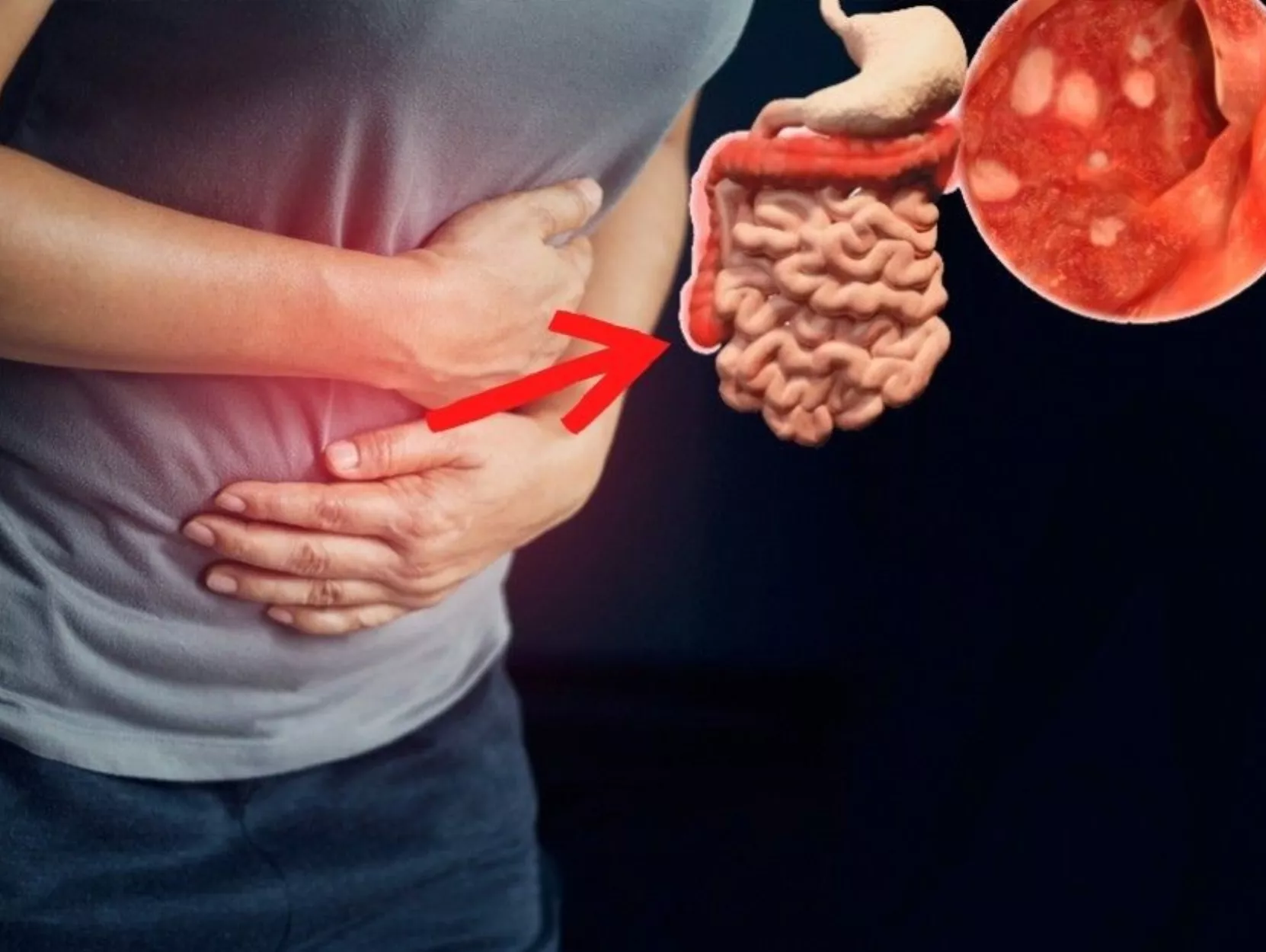 Colitis ulcerativa, condición sin síntomas propios y que se torna invisible