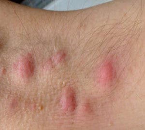 Conozca el riesgo de la  Hidradenitis Supurativa (HS)