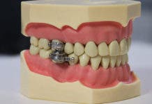 Vídeo: Presentan el «primer dispositivo del mundo para adelgazar» cerrando los dientes con un ‘candado’